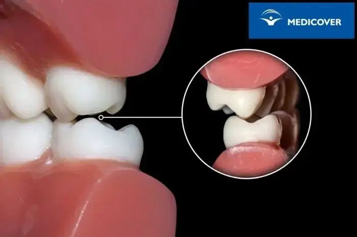 Kiedy założyć aparat na zęby? Wiek, objawy i przygotowanie