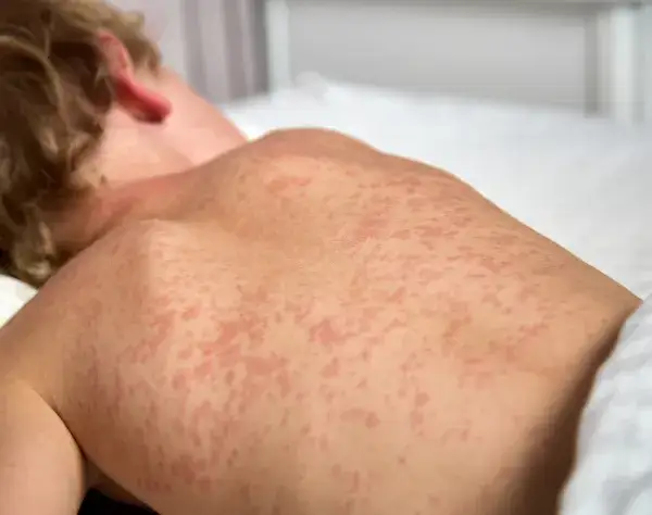 Sarpullido por medicamento: ¿Alergia? Síntomas y cuándo ir a urgencias.