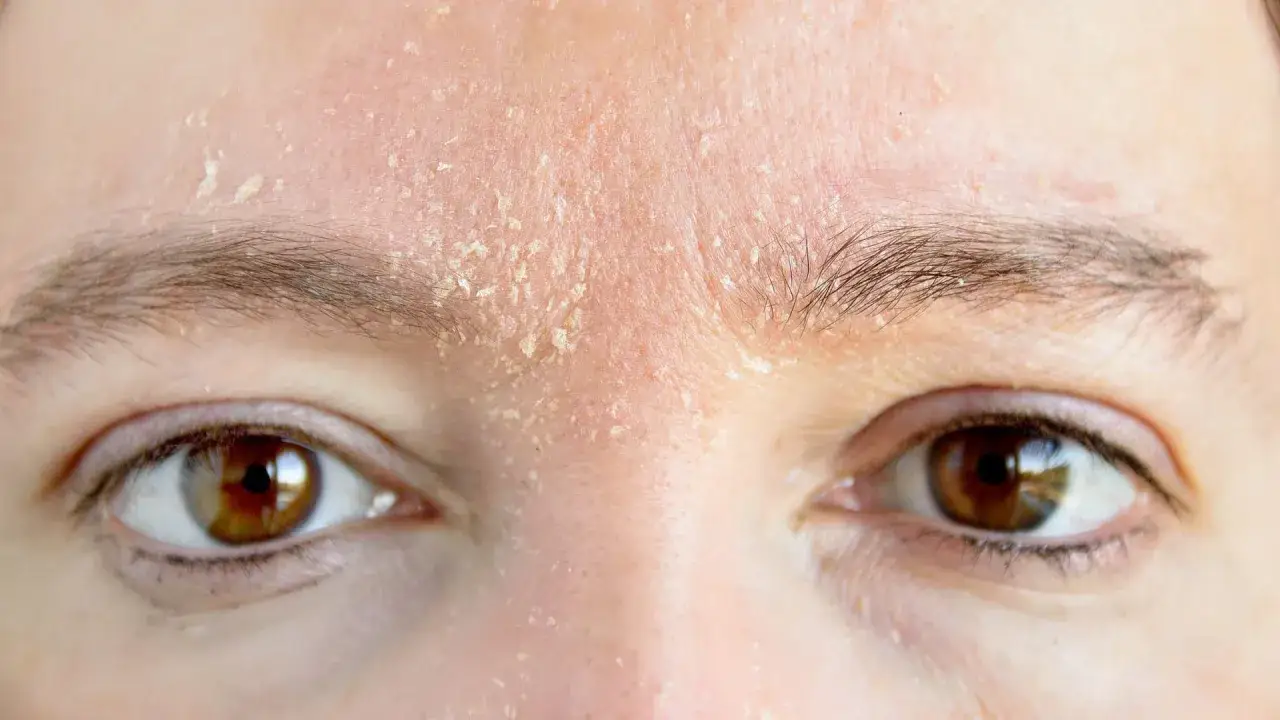 Gesichtshaut schuppt sich: Ursachen verstehen und effektiv behandeln