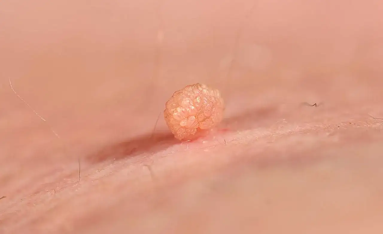 Kłykciny kończyste: Jak rozpoznać objawy i co robić?