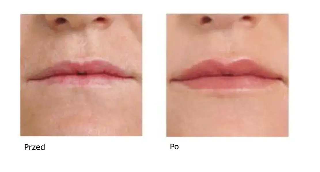 Ile utrzymuje się kwas hialuronowy na twarzy? Zaskakujące fakty o trwałości