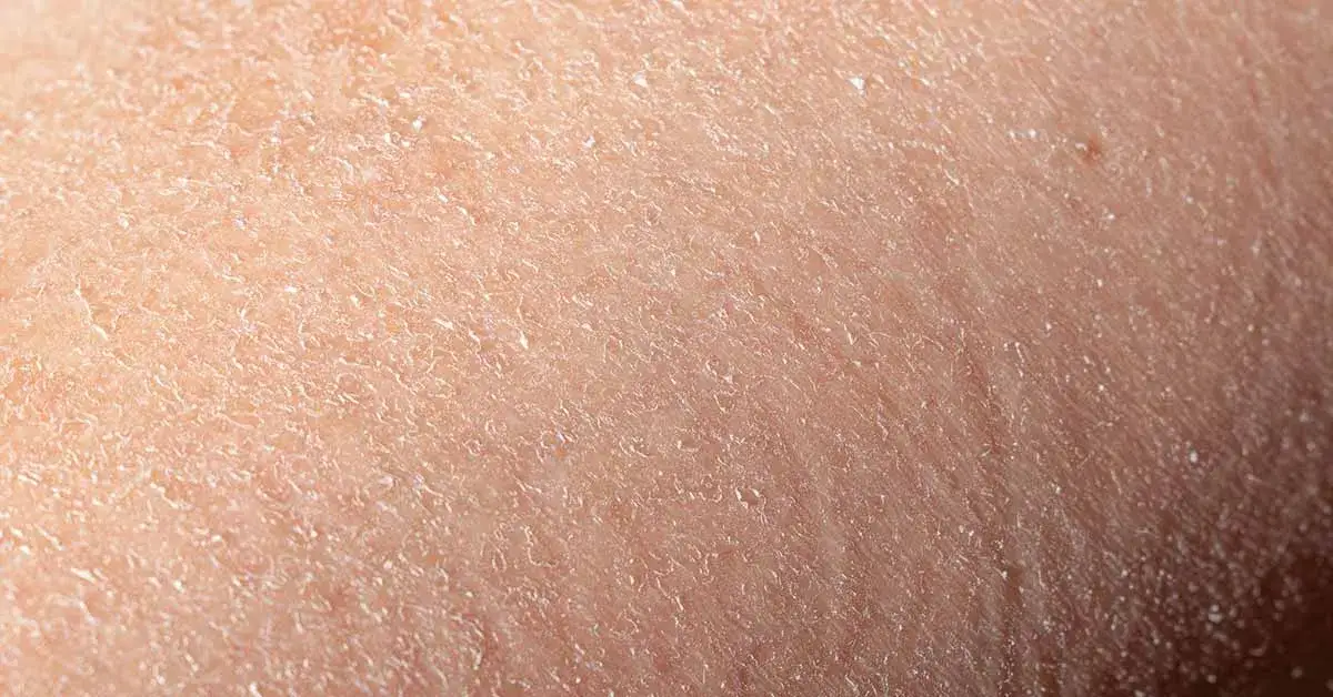 Ursachen und Lösungen für trockene schuppige Gesichtshaut verstehen