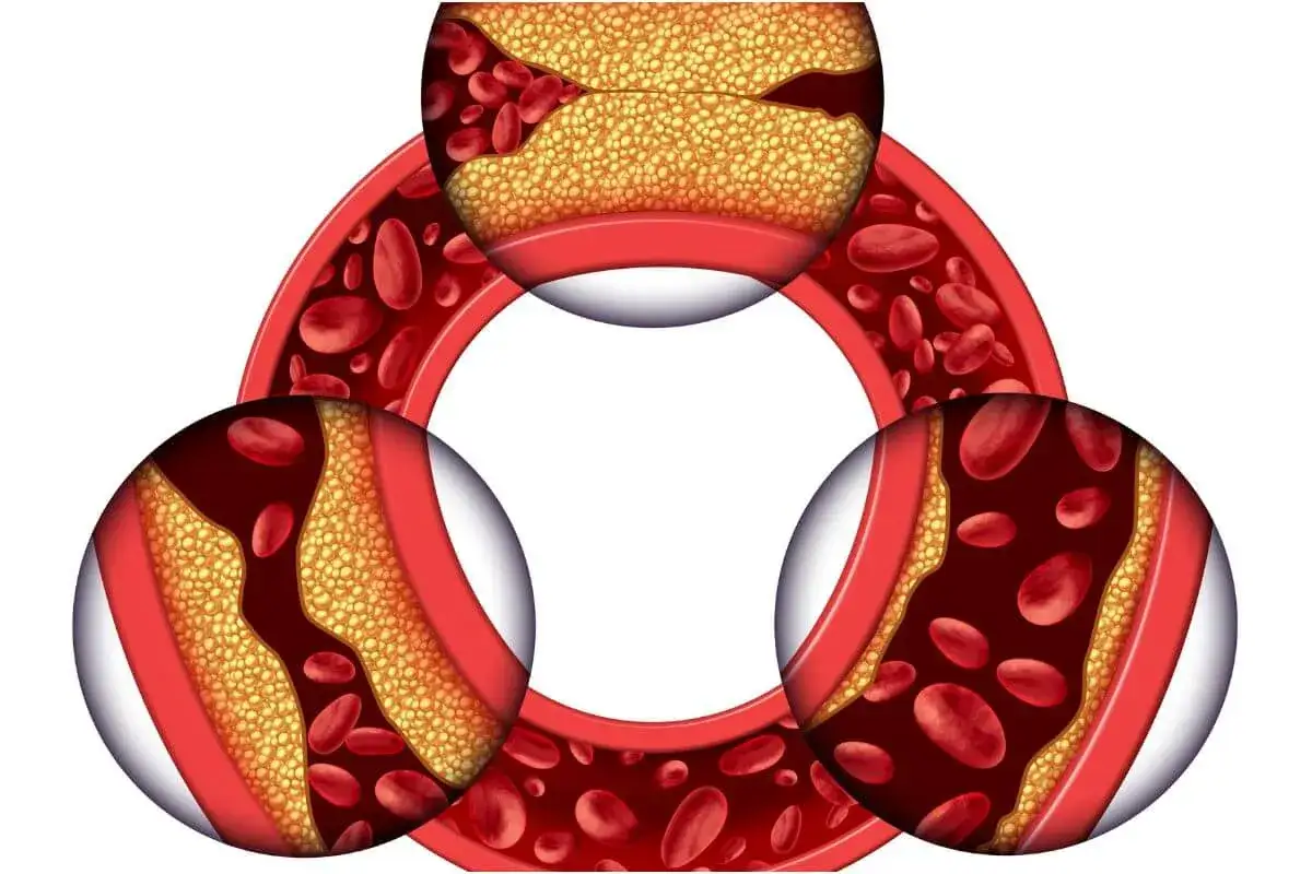 Ilustracja pokazuje zwężone naczynia krwionośne z blaszkami miażdżycowymi, co jest częstym problemem u osób starszych.