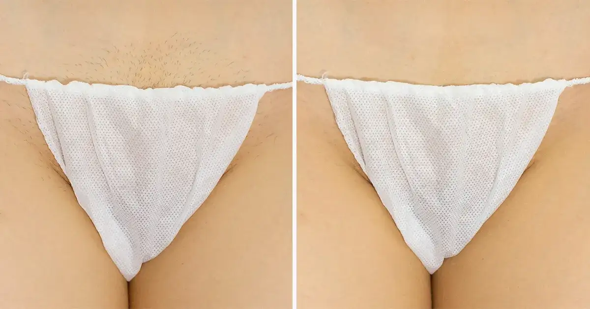 Bikini głębokie co to? Poznaj metody depilacji i efekty