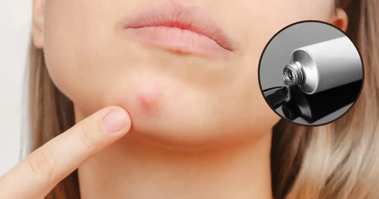 Maść ichtiolowa na pryszcz: Ile trzymać? Maksymalna skuteczność