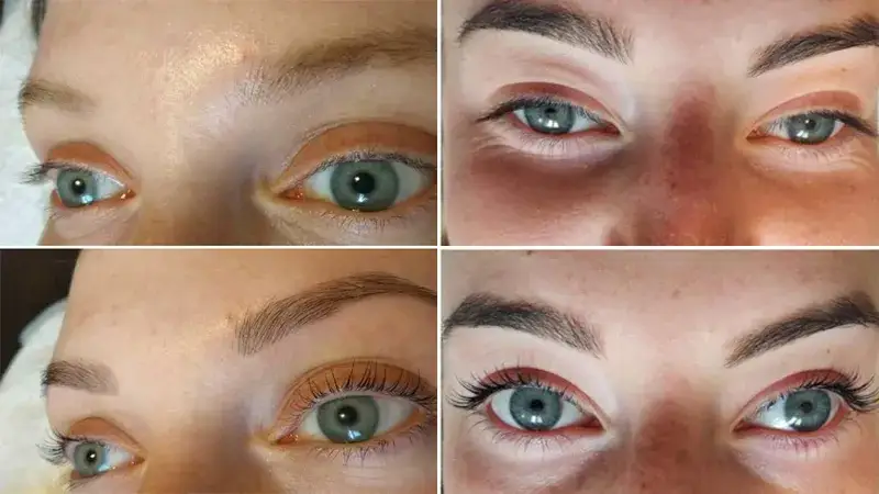 Botoks rzęs co to? Poznaj skutki, zalety i przebieg zabiegu