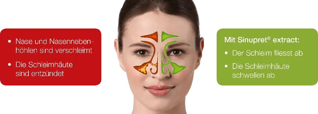 Die besten Medikamente bei Nasennebenhöhlenentzündung für schnelle Linderung