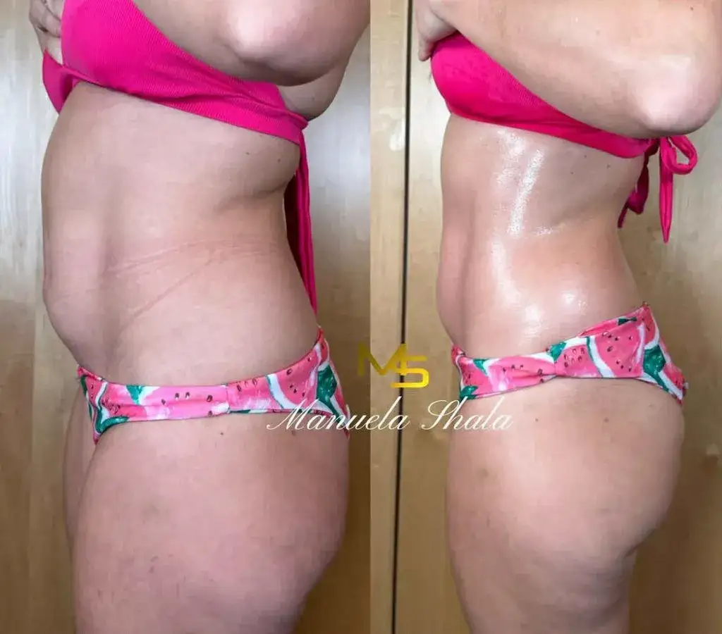 Drenaż limfatyczny: ile zabiegów potrzeba na trwałe efekty?