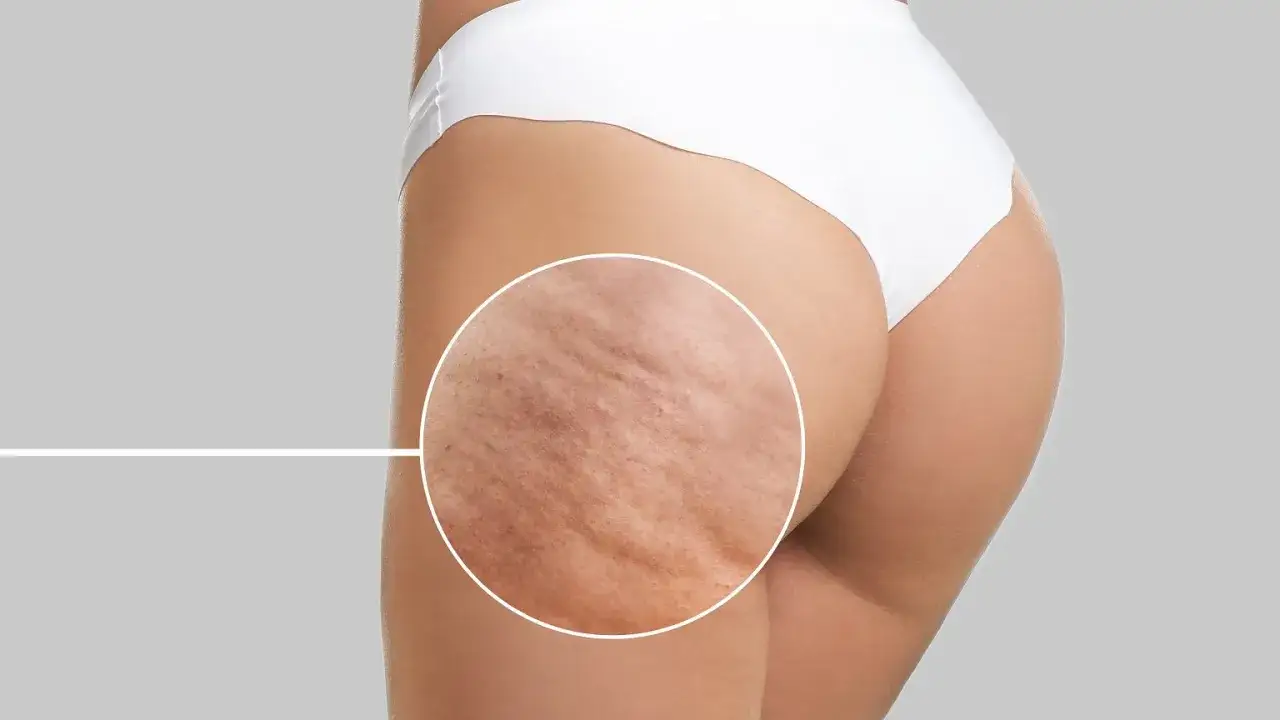 Cellulit na udach: Poznaj skuteczne metody i ciesz się gładką skórą!
