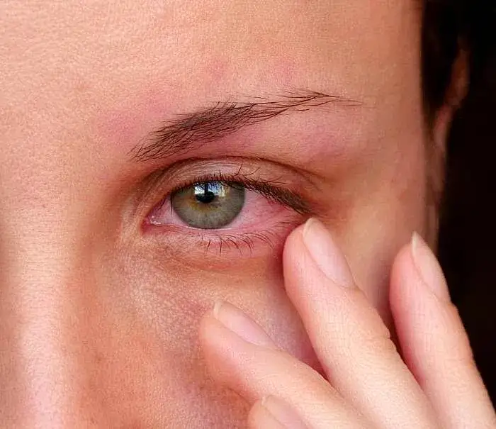 Swędzą Cię oczy? Alergia na płyn do soczewek co robić?