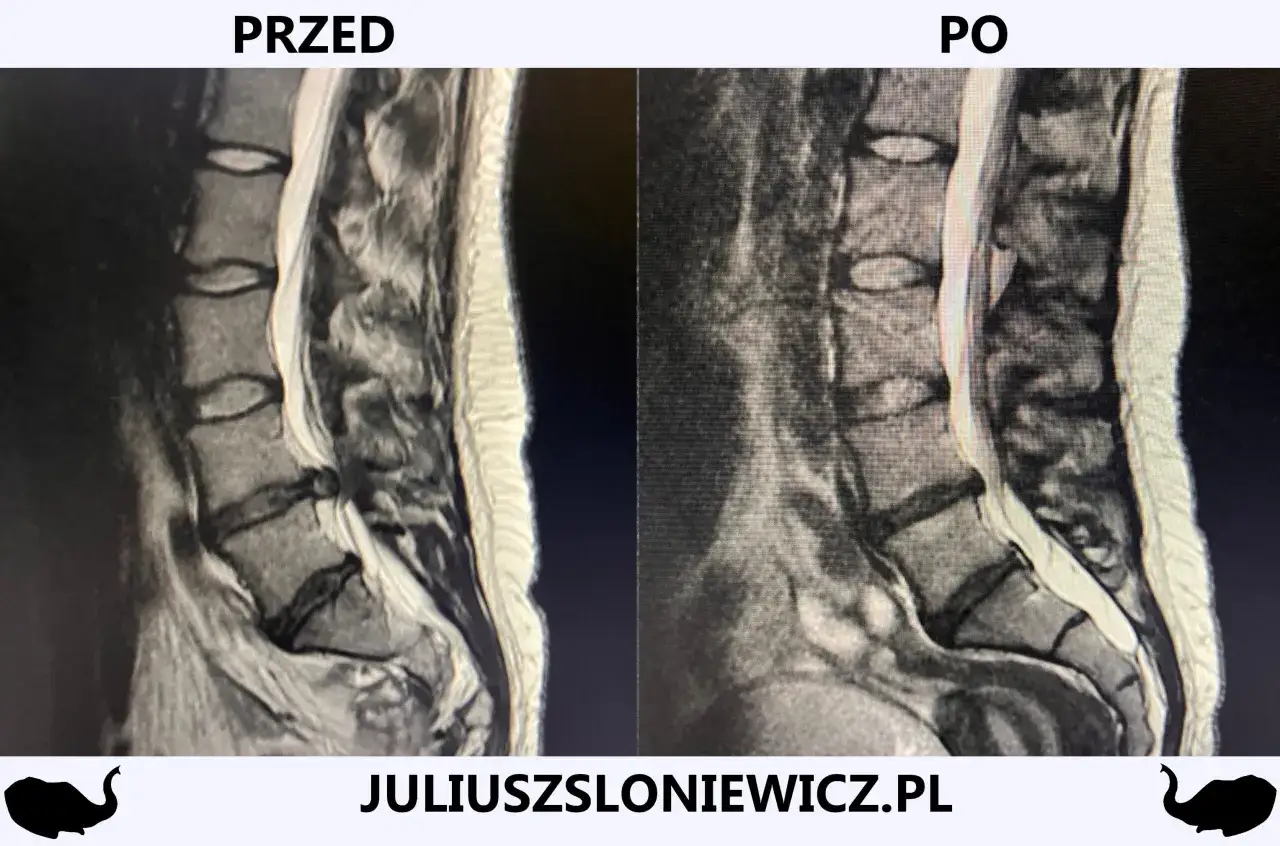 Rwa kulszowa: Zrozum objawy, znajdź ulgę i pokonaj ból!