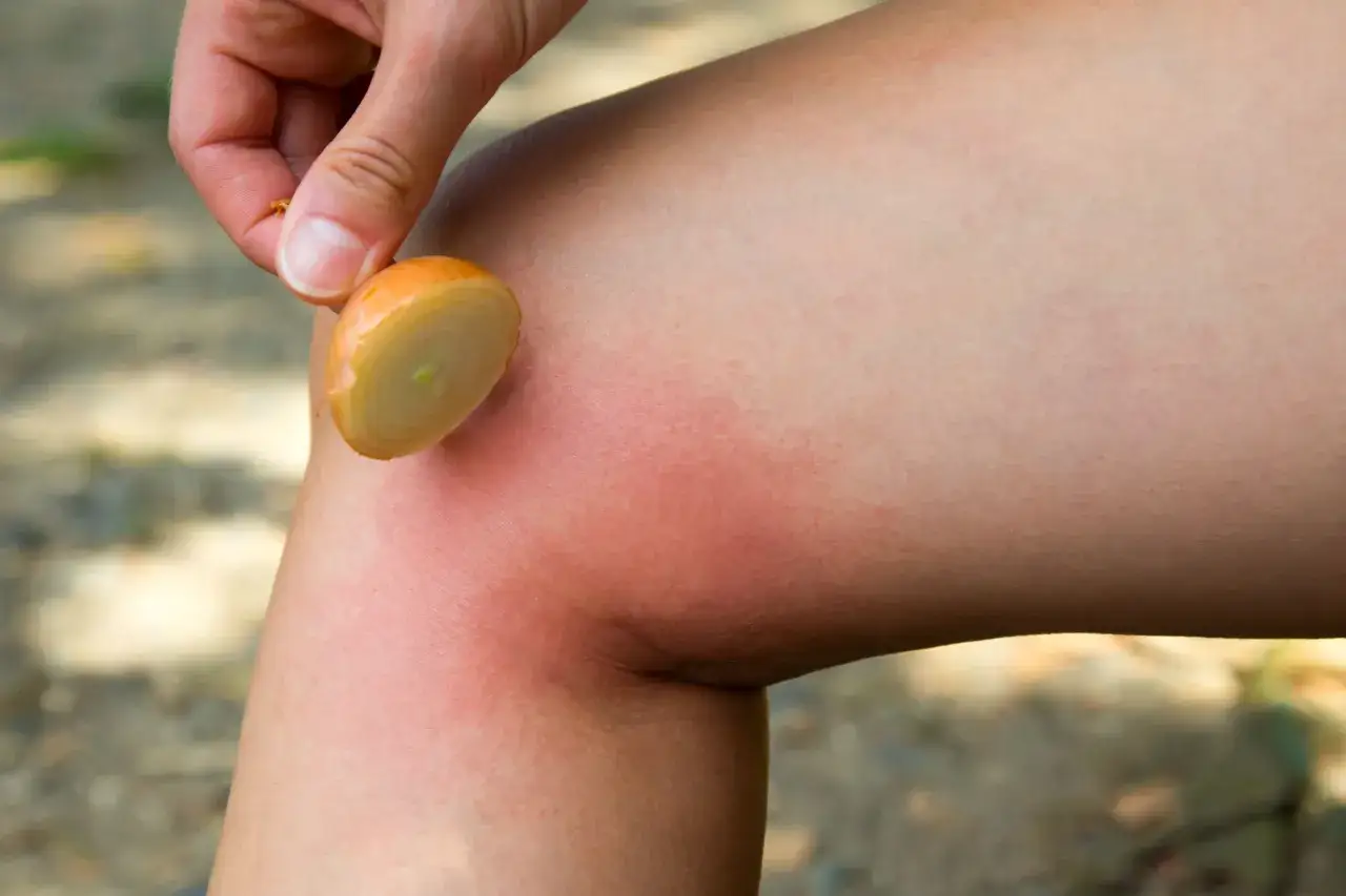 Użądlenie osy: Szybka pomoc, domowe sposoby i objawy alergii