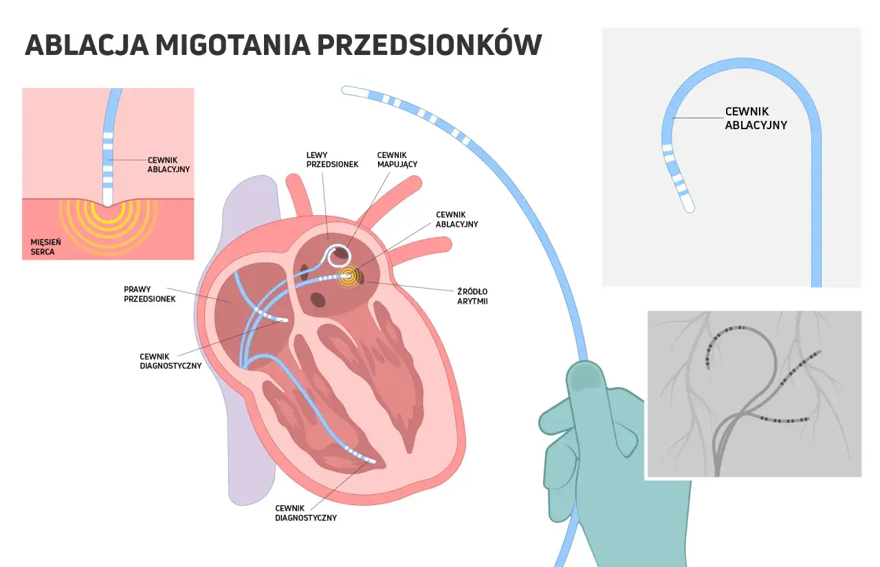 Ilustracja wyjaśnia, co to ablacja migotania przedsionków. Pokazuje cewniki diagnostyczne i ablacyjne w sercu, lokalizujące źródło arytmii.