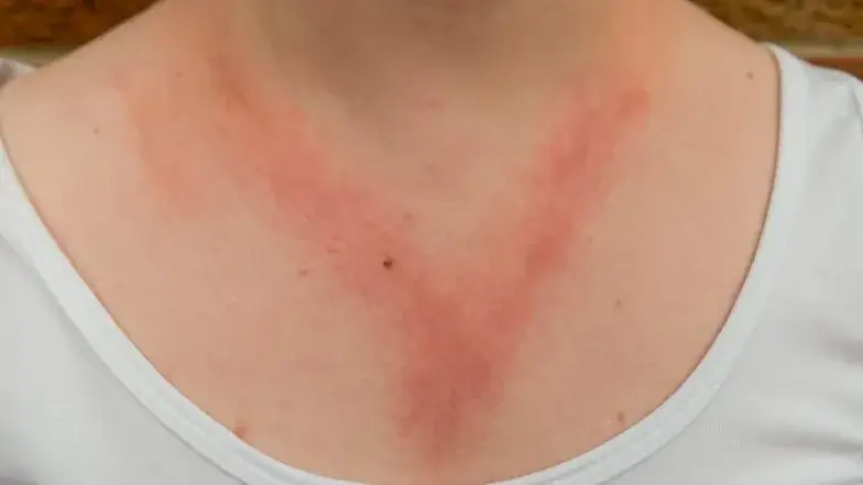 Jak skutecznie leczyć uczulenie na złoto i unikać nieprzyjemnych objawów