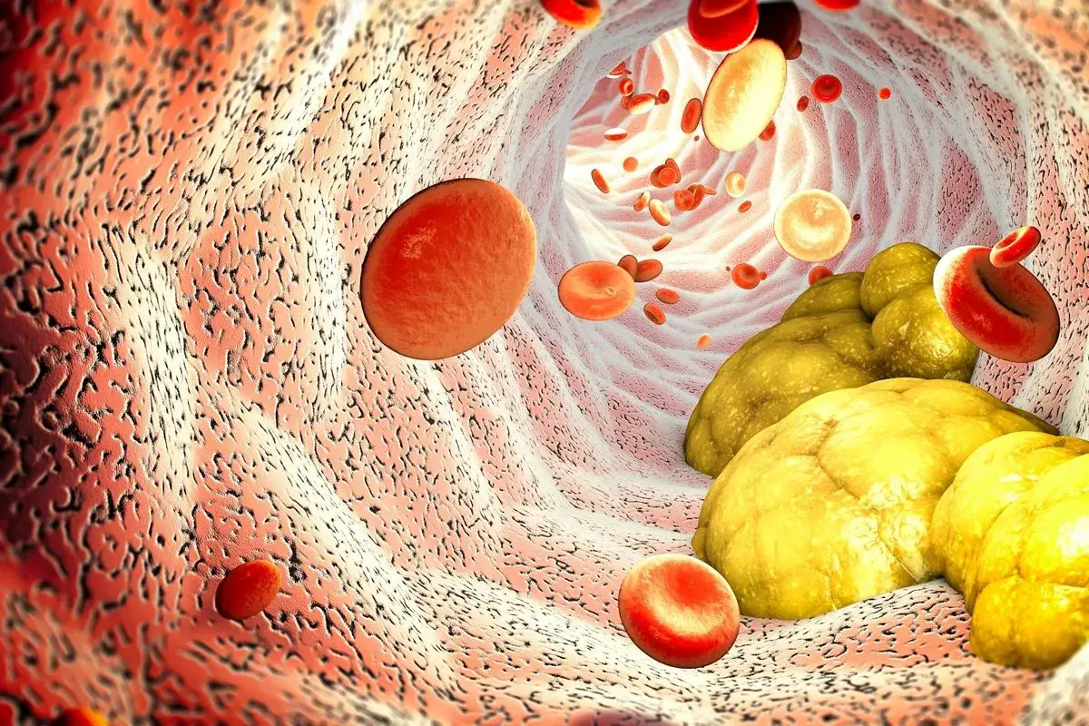 Zaburzenia lipidowe - co to znaczy i jak wpływają na zdrowie?