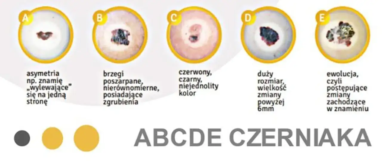 ABCDE czerniaka: asymetria, brzegi, czerwony/czarny kolor, duży rozmiar, ewolucja. Obrazki pokazują, jak wygląda czerniak.