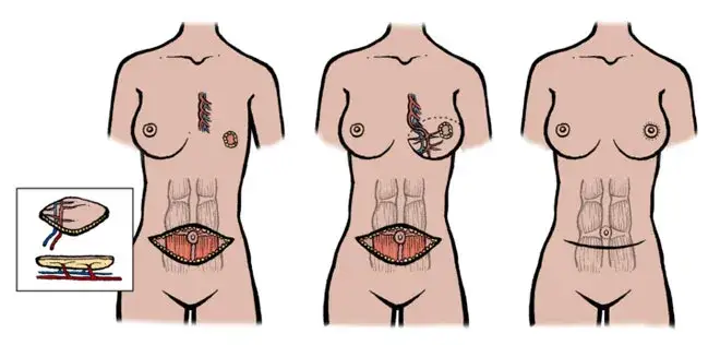 Gdzie znaleźć mastektomię z rekonstrukcją w NFZ bez dodatkowych kosztów