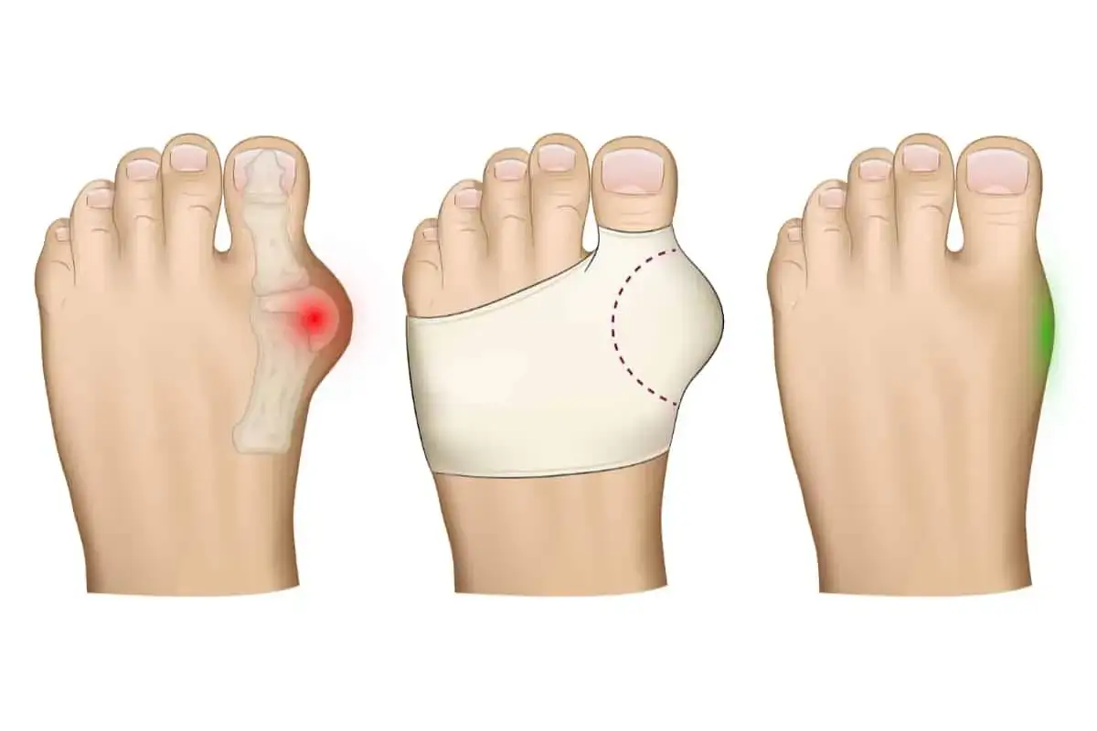 Trzy etapy stopy: ból haluksa, stabilizacja opaską, ulga po zabiegu. Wskazówki jak dbać o stopę po operacji haluksa.