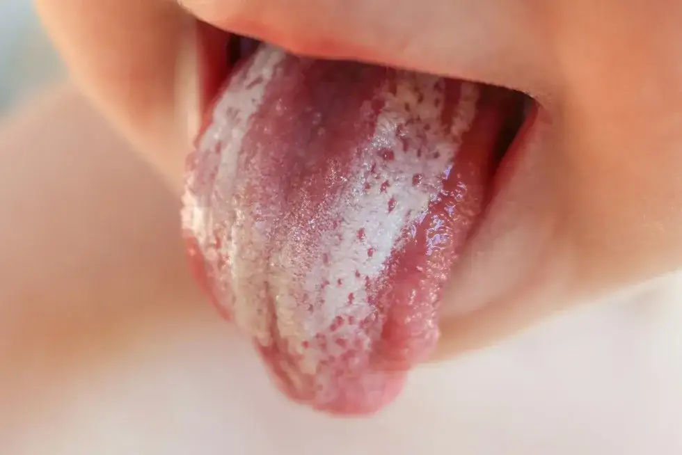 Skuteczne leki na grzybicę jamy ustnej - uniknij bólu i dyskomfortu