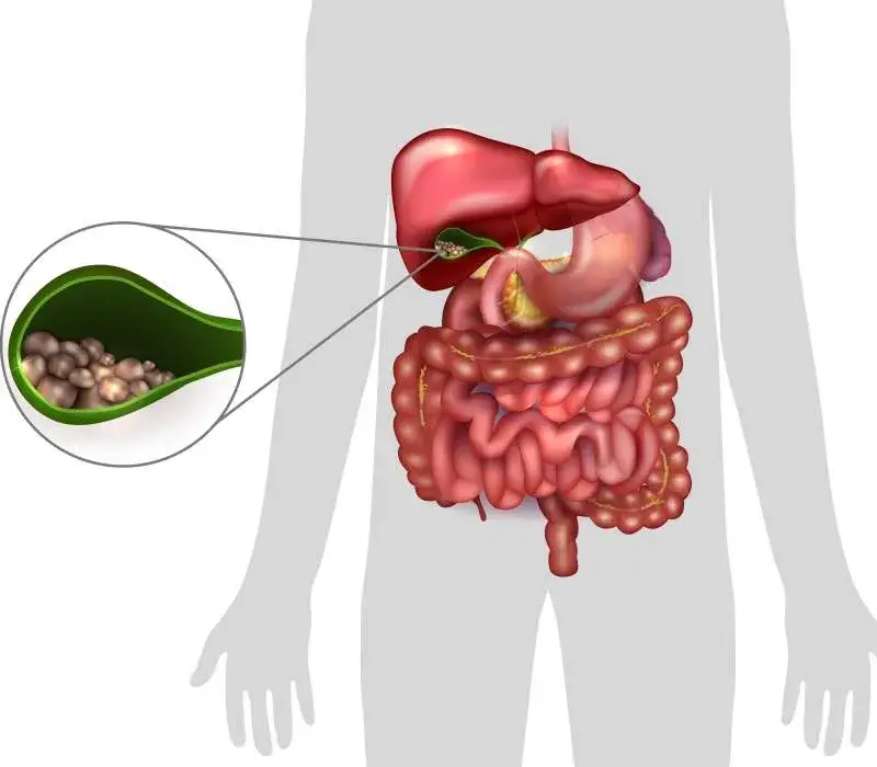 Síntomas de "vesícula sucia": ¿Qué te dice tu digestión?