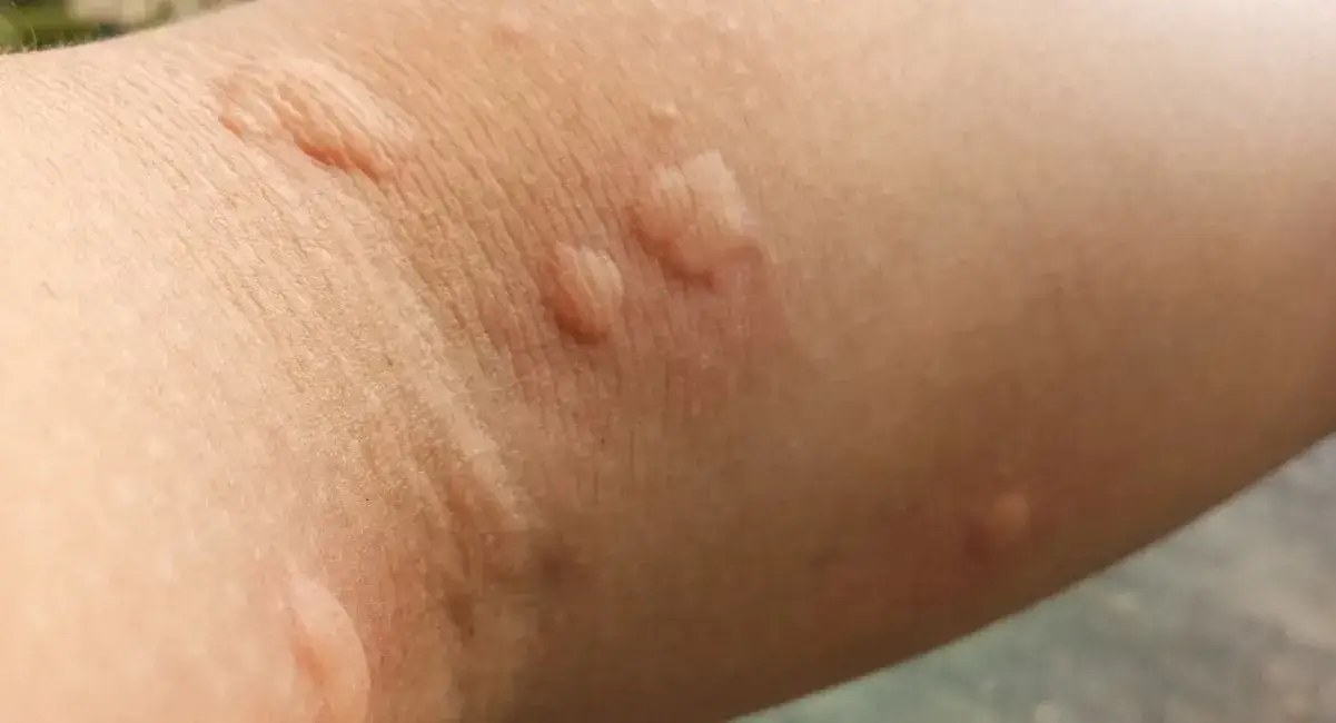 Próba uczuleniowa: Kluczowe badanie w diagnostyce alergii