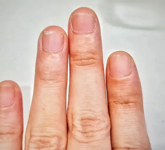 Czarne kreski pod paznokciami jak drzazgi – co mogą oznaczać?