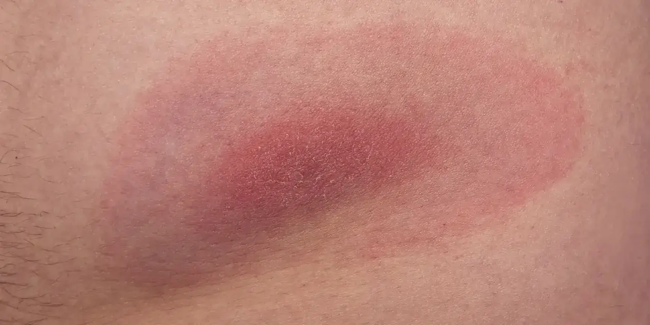 Czym smarować miejsce po kleszczu, aby uniknąć zakażenia?