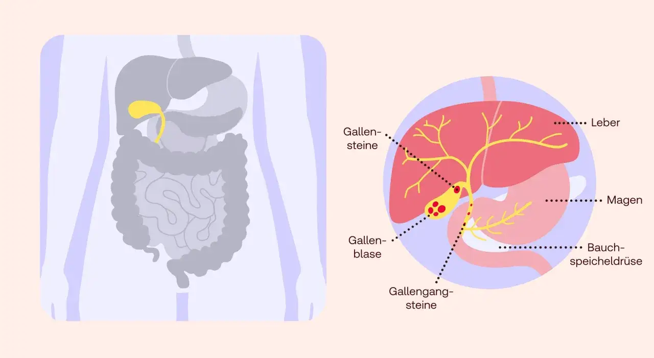 Gallensteine: Symptome erkennen & wann Sie handeln sollten