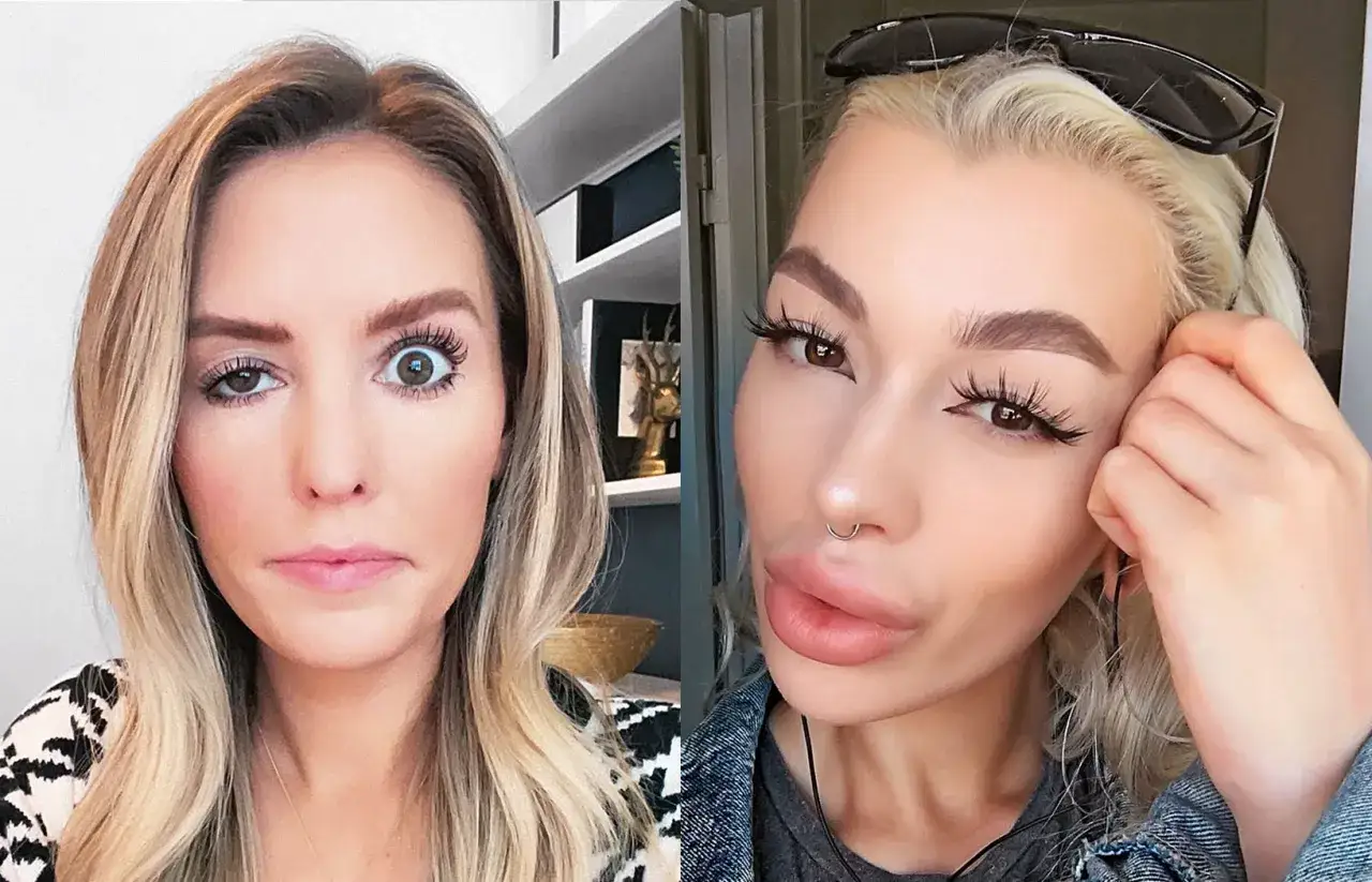 Jakie efekty botoksu po jakim czasie? Oczekuj widocznych zmian!