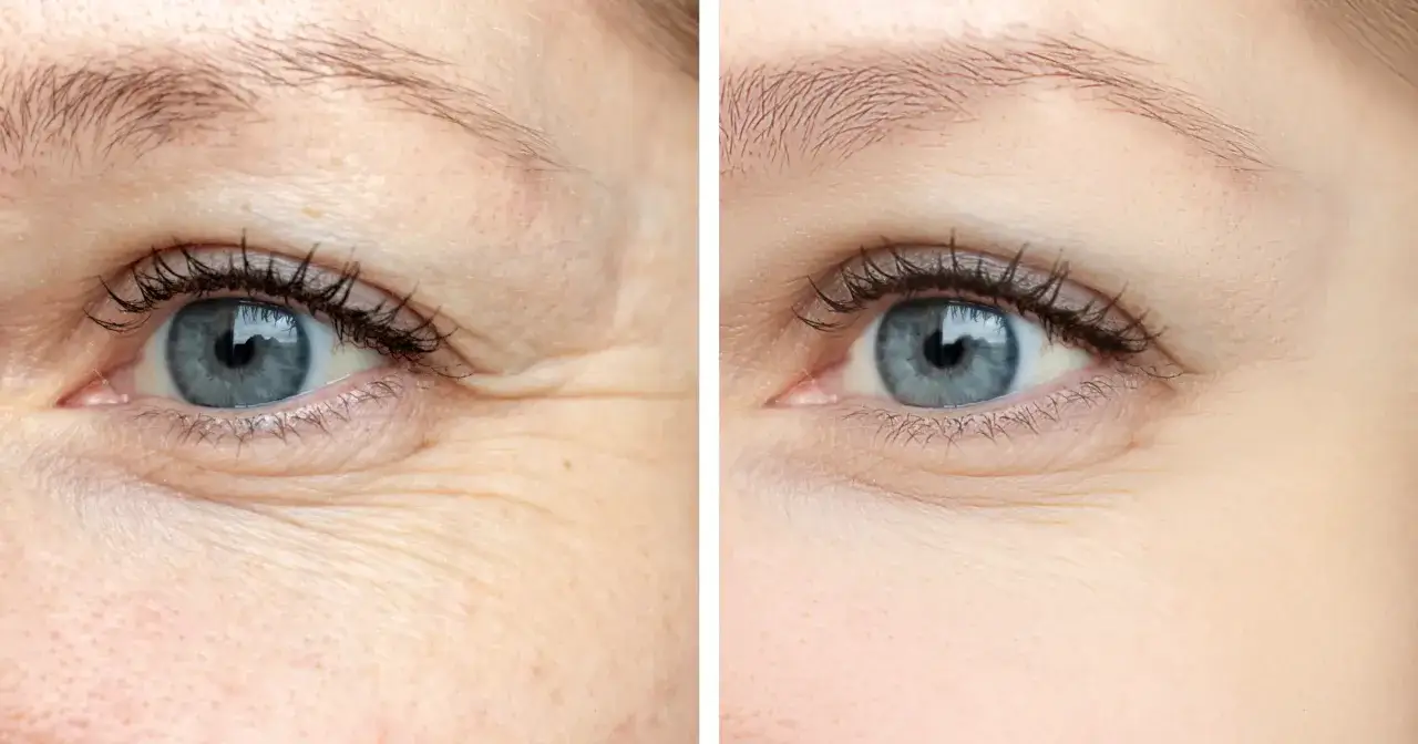 Ile kosztuje botoks pod oczy? Nie przepłacaj! Poradnik eksperta