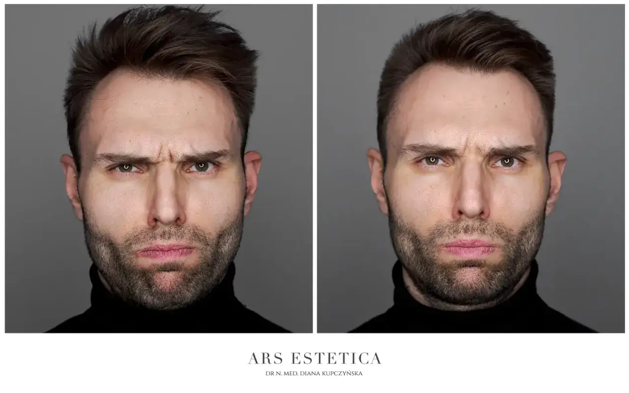Brak efektu po botoksie? Ekspert wyjaśnia i radzi, co dalej