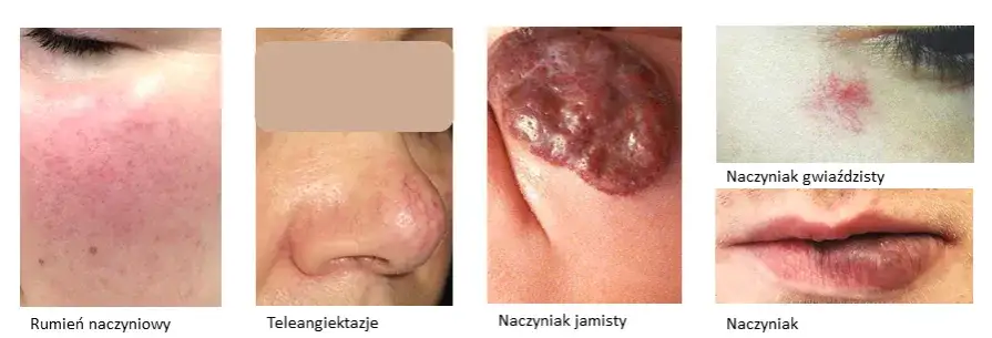 Zmiany naczyniowe na skórze: przyczyny, objawy i skuteczne leczenie
