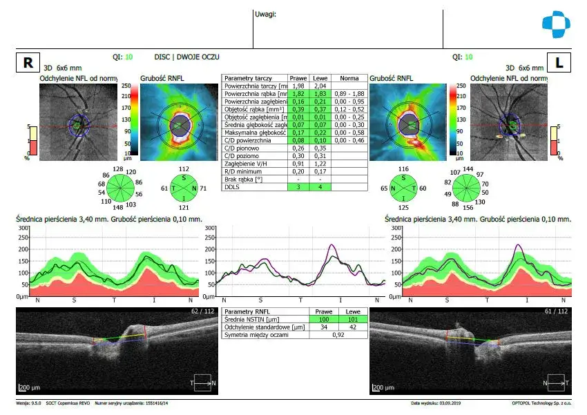 Badanie OCT: Co to jest, jak przebiega i czy wykryje jaskrę?