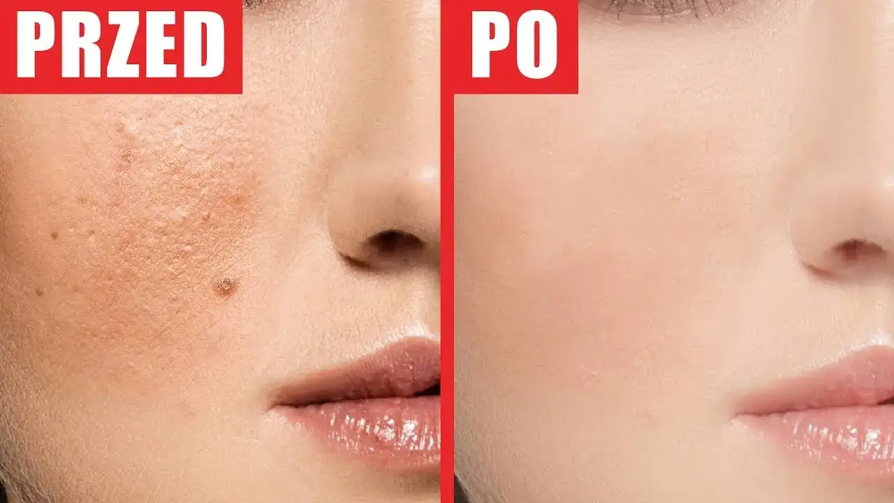 Jak zatuszować pryszcza: skuteczne sposoby na ukrycie niedoskonałości
