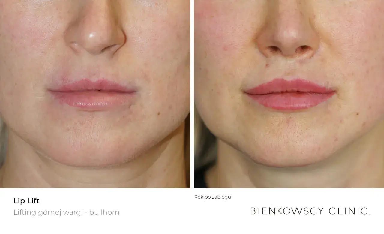 Powiększanie ust: Zmniejsz obrzęk! Sprawdzone metody i kiedy do lekarza