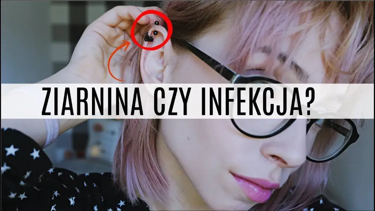 Jak skutecznie leczyć ziarninę po piercingu i uniknąć powikłań