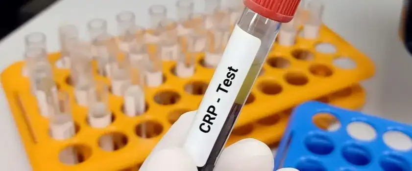 Badanie CRP: Co oznacza Twój wynik? Normy i przyczyny