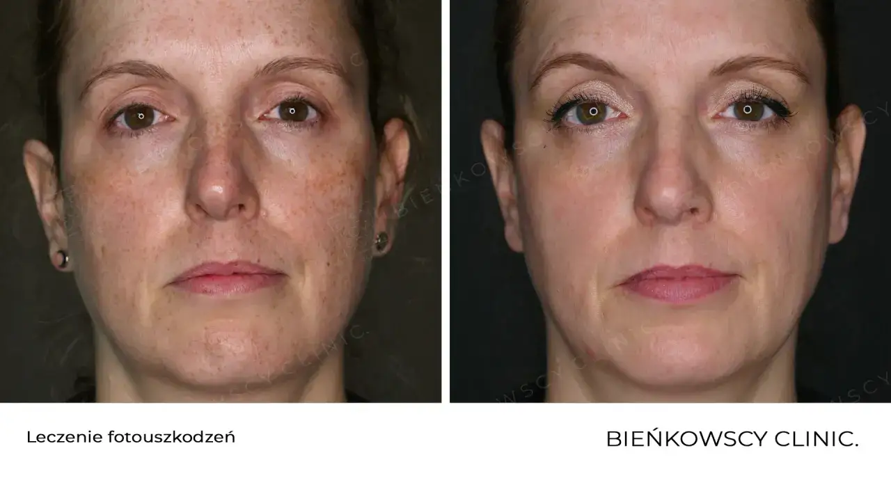 Jak pozbyć się przebarwień? Przewodnik do jednolitej cery!