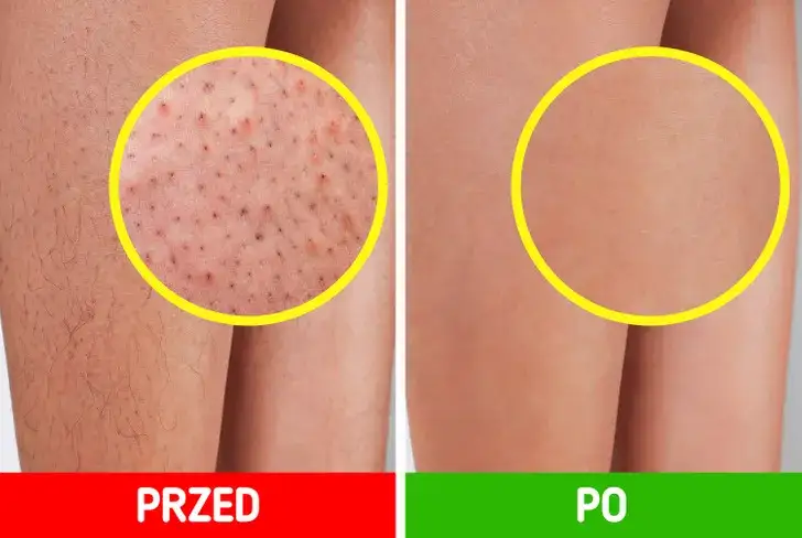 Jak pożegnać „truskawkowe nogi”? Gładka skóra po goleniu!