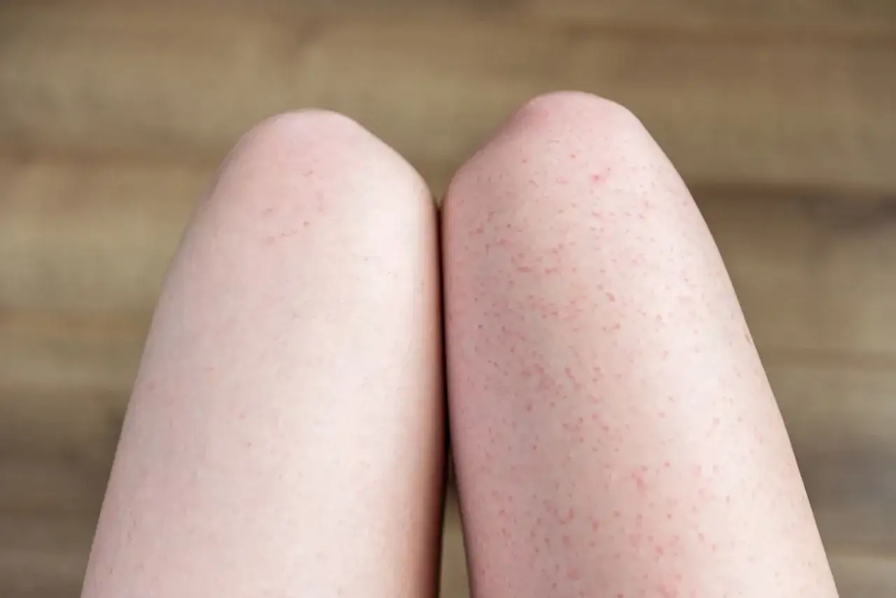 Czerwone kropki po goleniu nóg - dlaczego się pojawiają i jak ich uniknąć