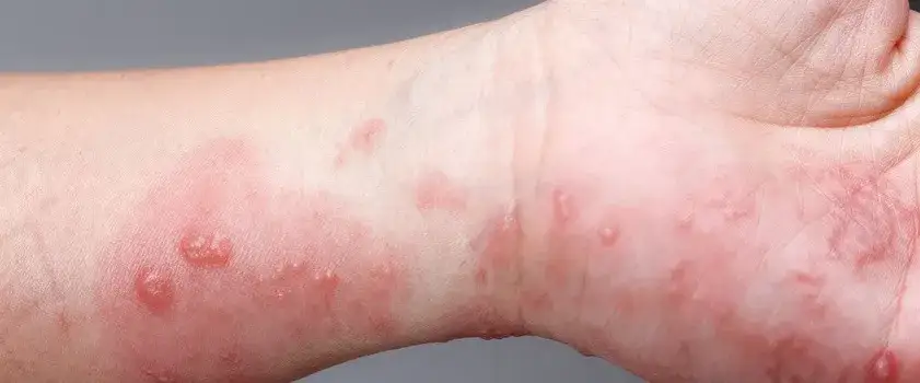 Skuteczne leki na świerzb, które pomogą Ci pozbyć się problemu