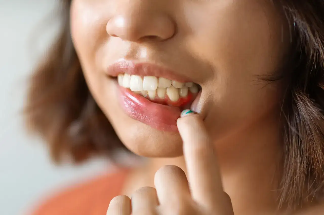 Zbliżenie na usta kobiety z widocznym zaczerwienieniem dziąseł, dotykane palcem.