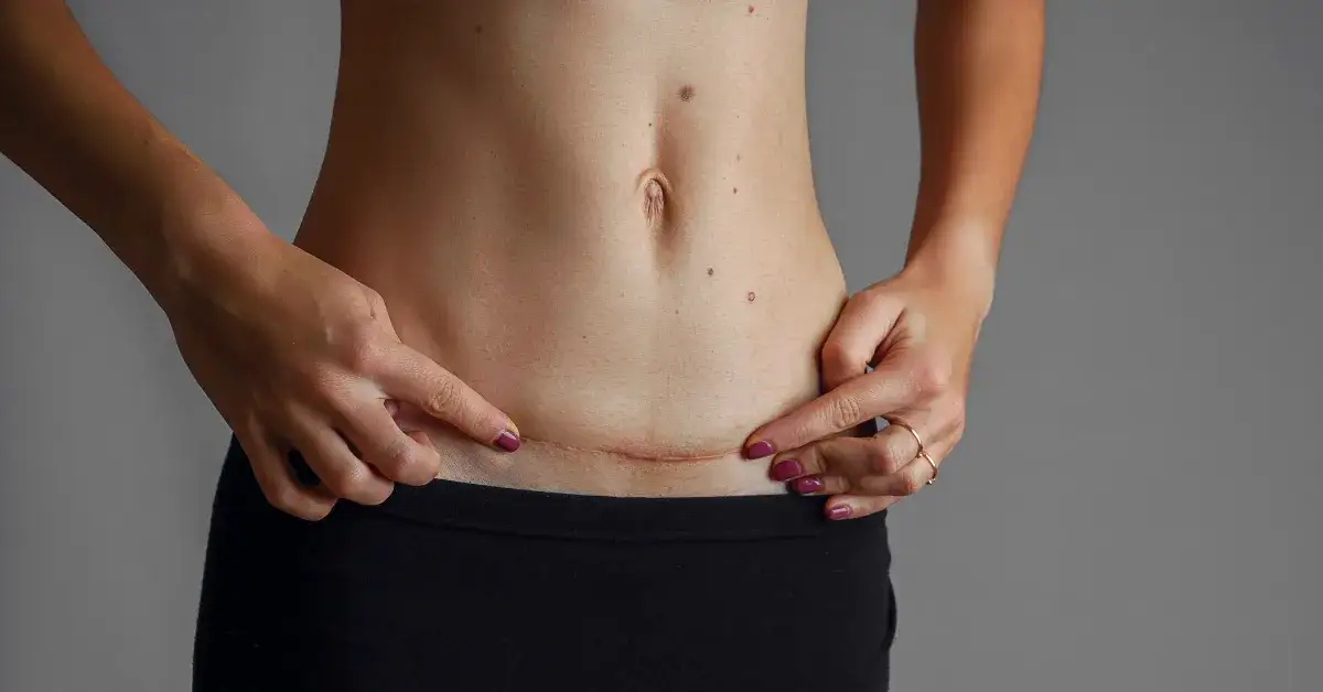 Kiedy można się golić po cesarce? Sprawdź, aby uniknąć bólu