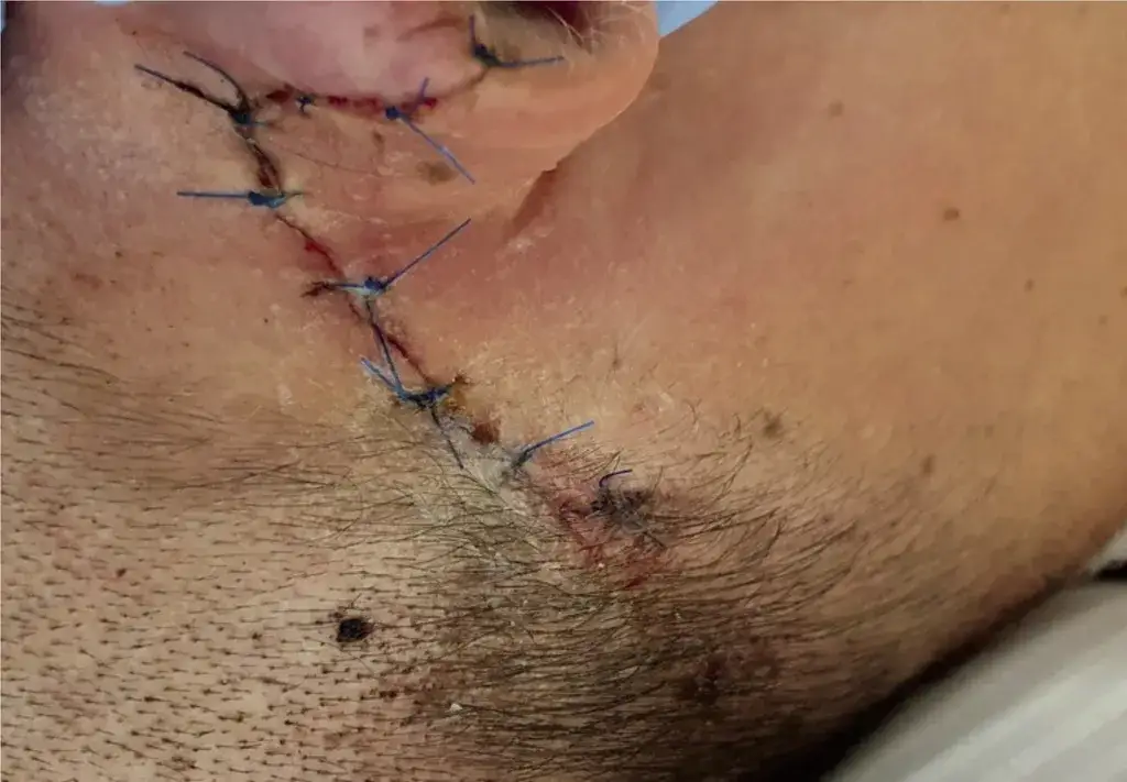 Opuchlizna po złamaniu kości jarzmowej: objawy i leczenie