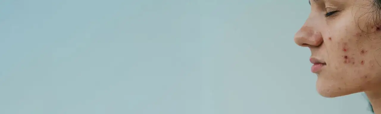 Skąd się biorą pryszcze? Odkryj przyczyny i jak ich uniknąć