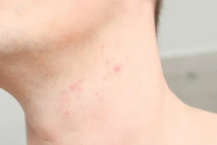 Jak złagodzić podrażnienia po goleniu? Gładka skóra bez krostek!