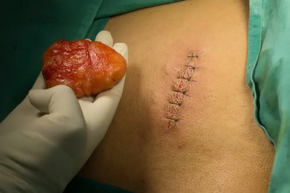 Do jakiego lekarza najlepiej udać się z tłuszczakiem? Sprawdzona porada