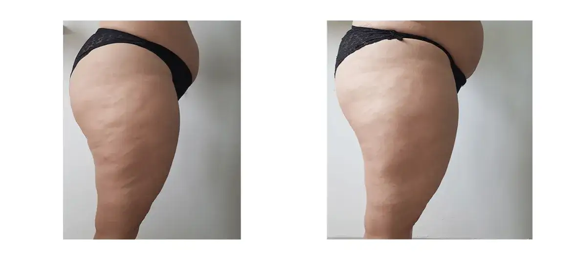 Endermologia Warszawa: Gdzie najlepiej i na co uważać?