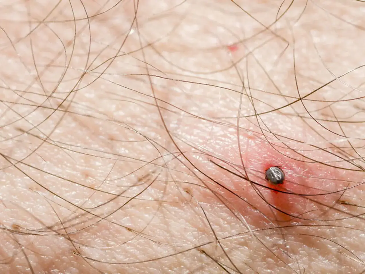 Kleszcz: objawy po ugryzieniu. Rumień, KZM kiedy alarmować?