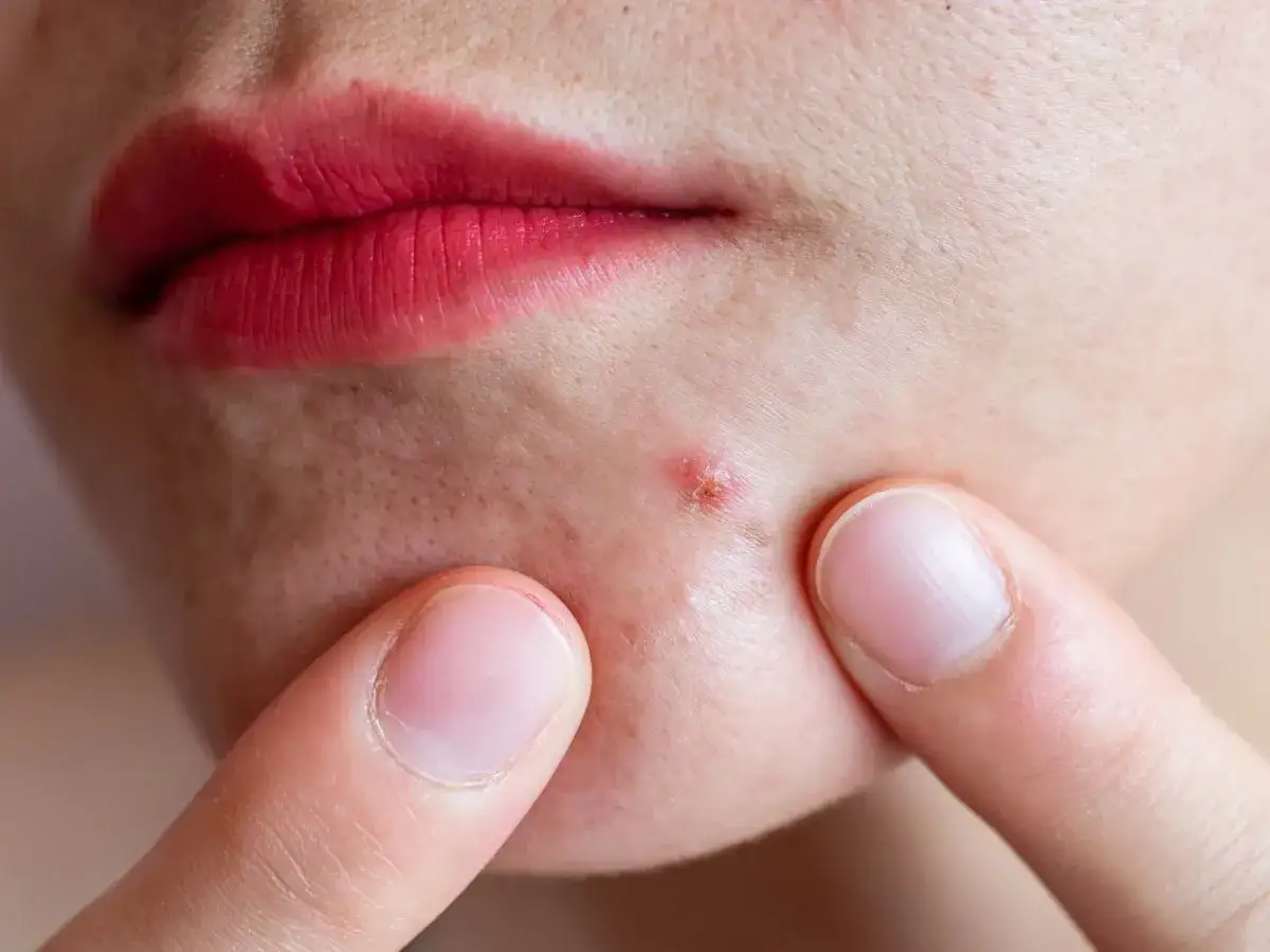 Pryszcze na brodzie: Czy to hormony? Sprawdź, jak je pokonać!